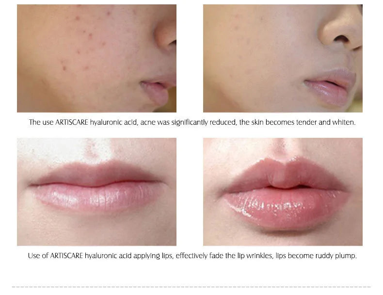 ARTISCARE Hyaluronic Acid Face Serum 4pcs/Lot for Moisturizing and Hydrating Facial HA Essence Face Care Products